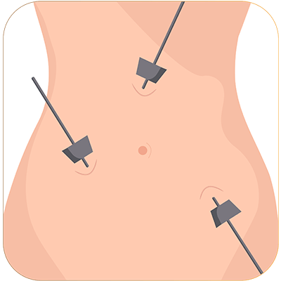 Laparoscopy operation